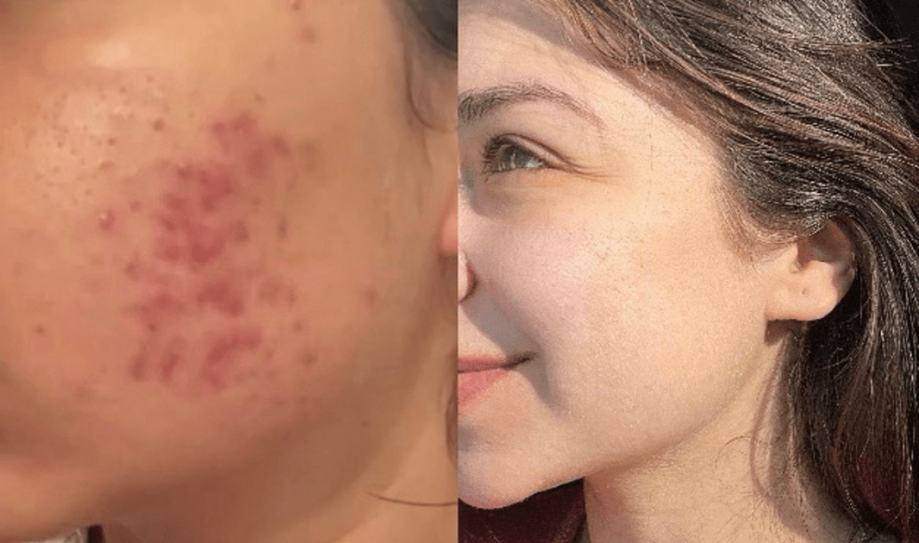 The Ultimate Anti-Acne Diet: Foods That Clear Acne&nbsp;Naturally